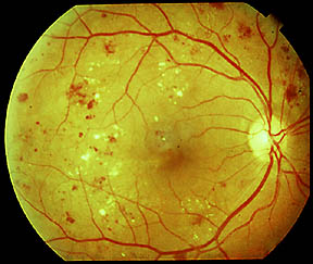 Retinopatia diabetica