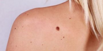 Cancerul de piele. 35 de cazuri noi la Spitalul Județean, în doar 6 luni. Ce recomandă medicii