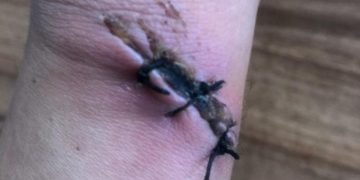 Anchetă la un spital, după ce medicii au fost acuzaţi că au cusut o rană ca la „abator”