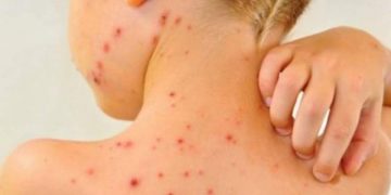 Epidemie de rujeolă în 7 județe în România