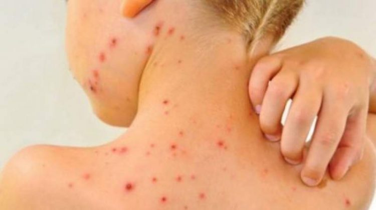 Epidemie de rujeolă în 7 județe în România