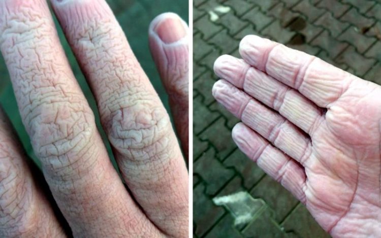 Acestea sunt mâinile unui cadru medical din Suceava după 12 ore de muncă