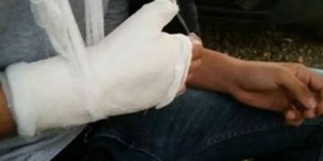 O fetiță de 11 ani din Maramureș a ajuns la spital, după ce o petardă i-a explodat în mână