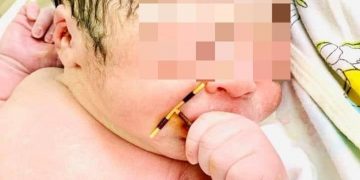 Un bebeluș s-a născut cu steriletul mamei în mână