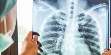 Şapte oameni au murit după ce medicii le-au recomandat să bea acid de baterie înainte de radiografii