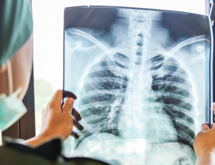 Şapte oameni au murit după ce medicii le-au recomandat să bea acid de baterie înainte de radiografii