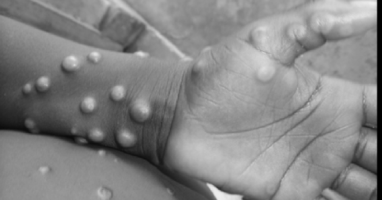 O nouă pandemie? -Ce spune OMS despre variola maimuței, boala care se extinde halucinant de rapid
