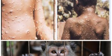 Primul caz de variolă a maimuței depistată la un român