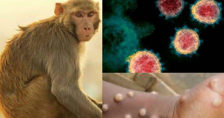 Primul caz de variola maimuței diagnosticat în România