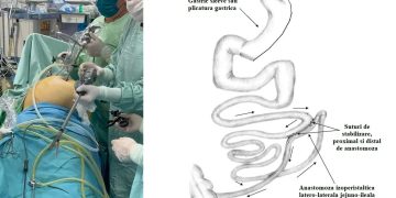 Premieră la Spitalul Județean din Baia Mare