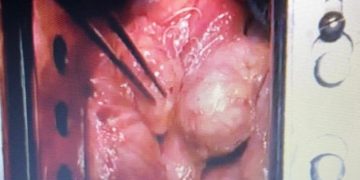 Intervenție chirurgicală complexă de succes la Spitalul Județean de Urgență ”Dr.Constantin Opriș” Baia Mare