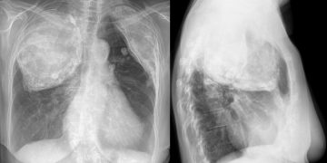 Alertă în Maramureş: medicii remarcă o creştere a cazurilor de tuberculoză în judeţ
