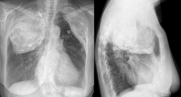 Alertă în Maramureş: medicii remarcă o creştere a cazurilor de tuberculoză în judeţ