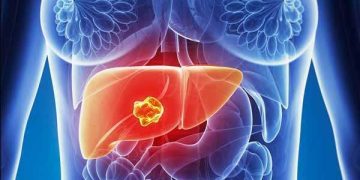 Vești bune pentru pacienții cu cea mai frecventă formă de cancer de ficat. Primul tratament cu imunoterapie