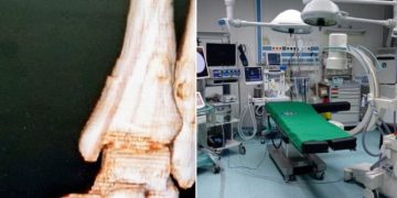 Operație de mare amploare la Spitalul Județean de Urgență Baia Mare. O fetiţă de 15 ani, supusă unei intervenţii de extirpare a două TUMORI OSOASE