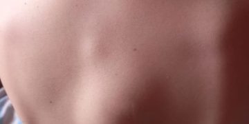 SĂ-L AJUTĂM! Un băieţel de 10 ani, din Târgu Lăpuş, are nevoie de noi pentru a face operaţie şi tratament în străinătate