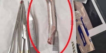 Din greșeală, un medic a uitat în rana unui pacient mânerul frânei de la bicicletă. Bărbatul a stat așa trei săptămâni, când a fost operat în Olanda