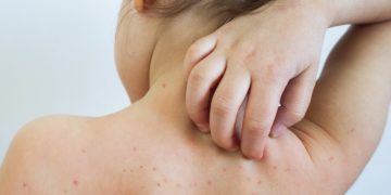 România, la un pas de o epidemie de rujeolă. Care este cauza