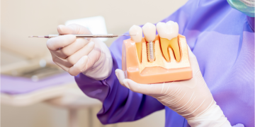 Diferențele între implanturi dentare și fațete dentare